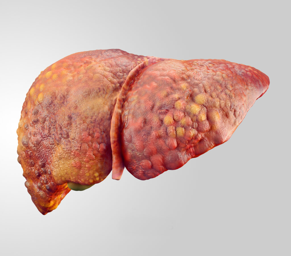 Realistic illustration of comparsion of healthy and sick (cirrhosis) human livers