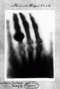 De eerste röntgenfoto, gemaakt van de hand van mevrouw Röntgen.